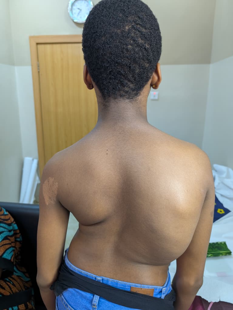Before: Progressive Scoliosis with Rib Hump